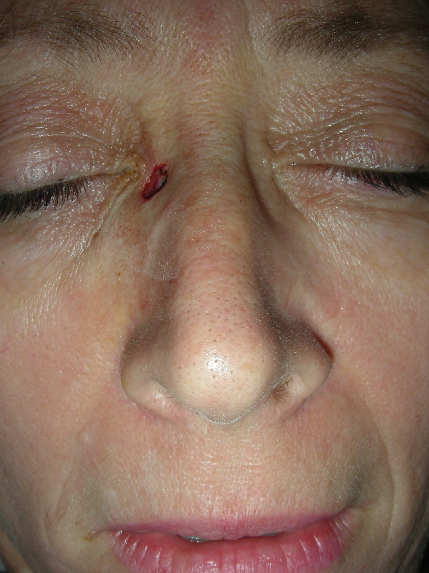 Mohs for Squamous Cell on Nose Prior to reconstruction