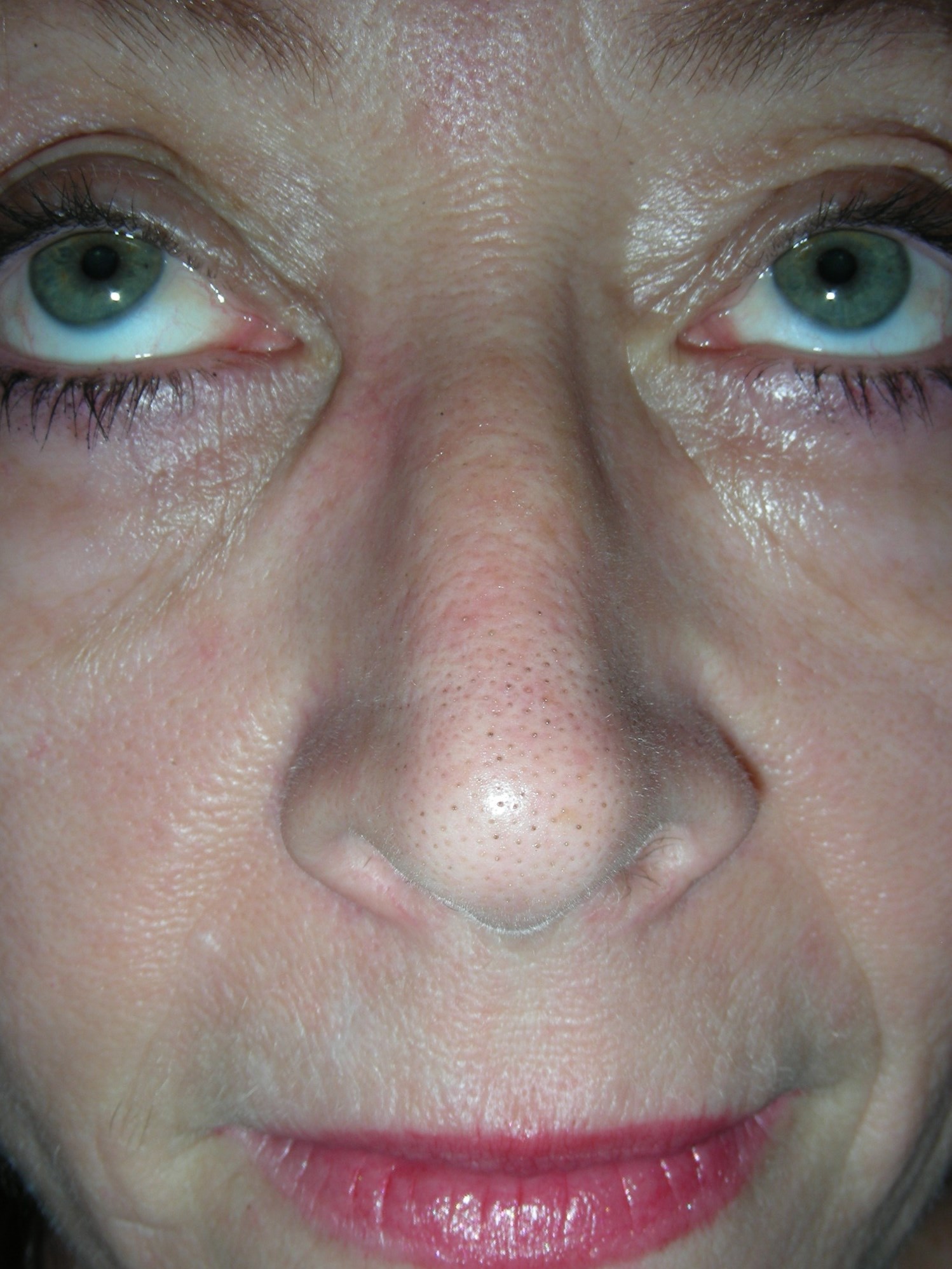 Mohs for Squamous Cell on Nose Six weeks post reconstruction