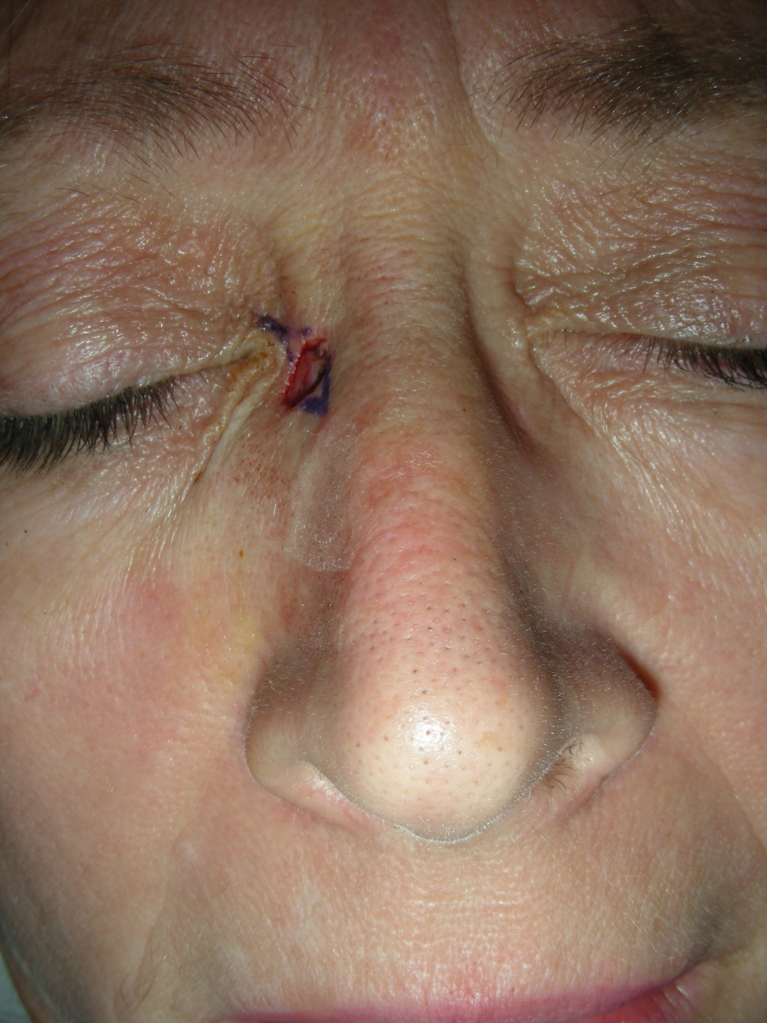 Intraoperative Photos Before reconstruction