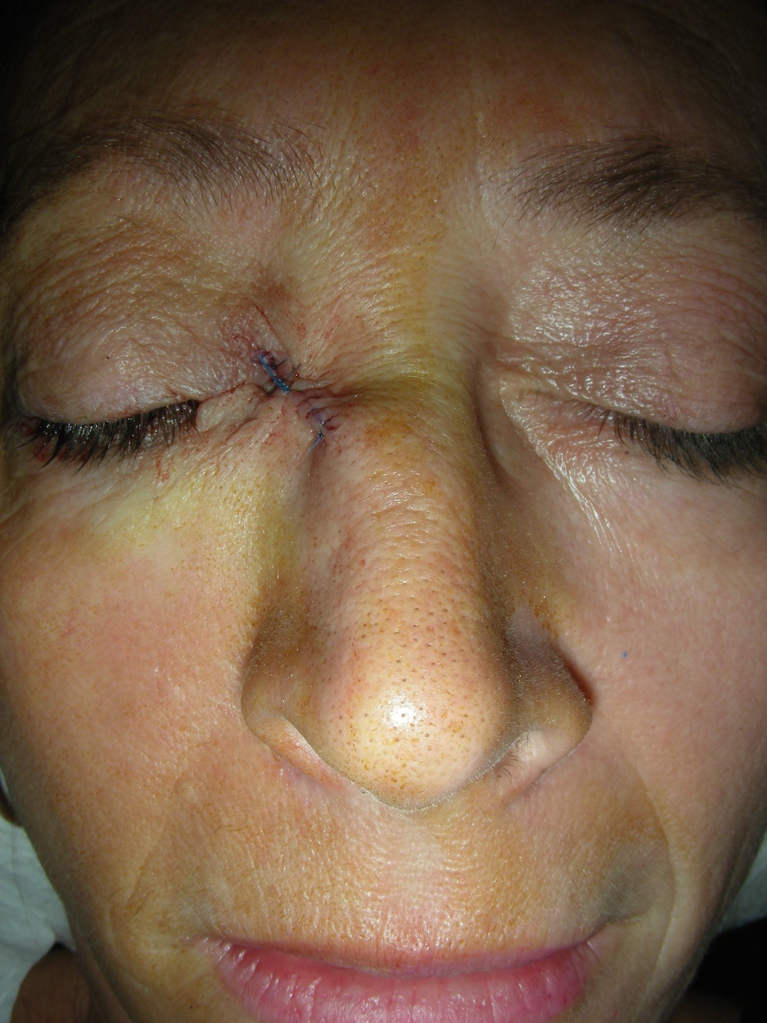 Intraoperative Photos After reconstruction