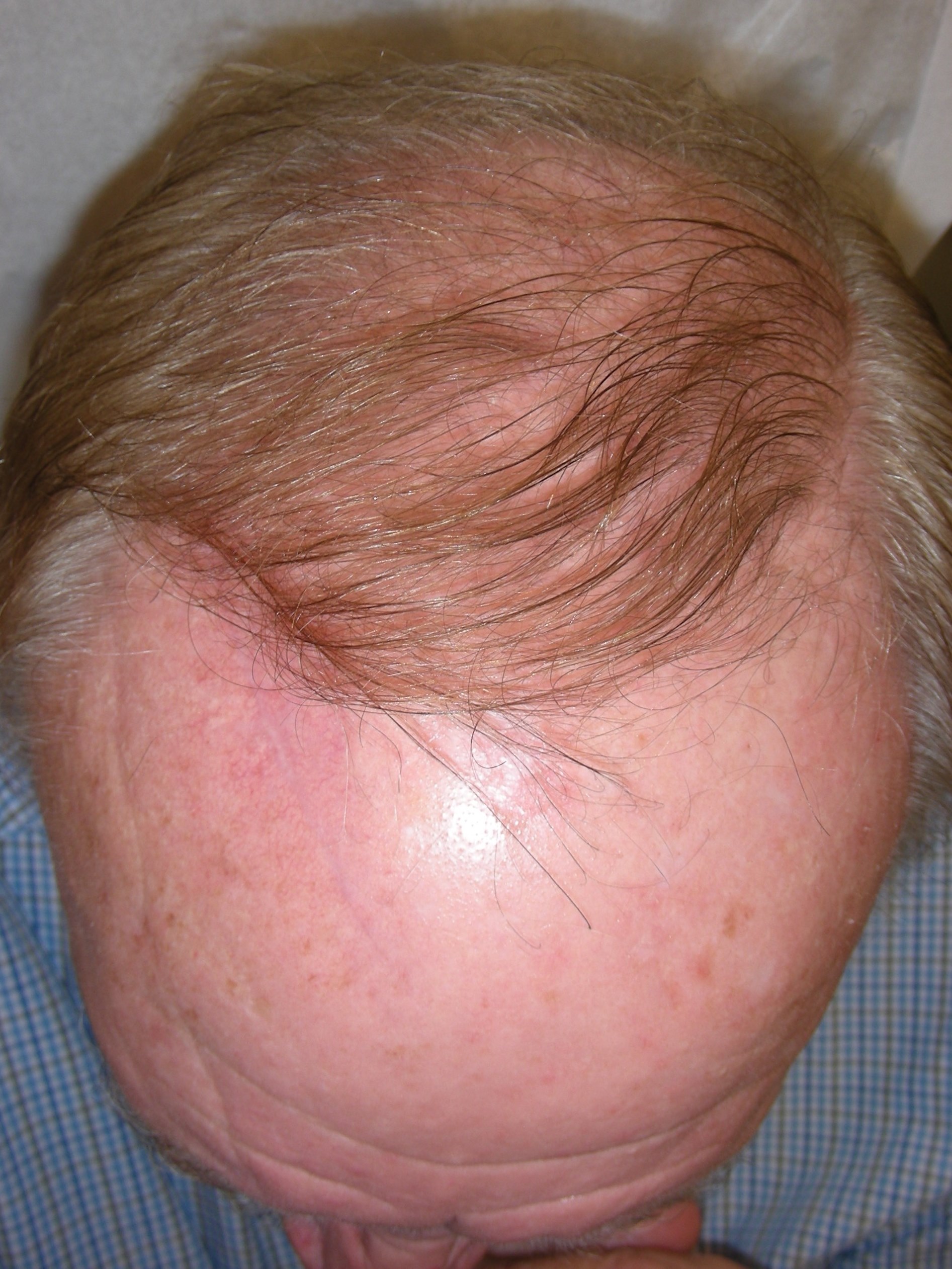 Mohs - Atypical Fibroxanthoma Six weeks post reconstruction