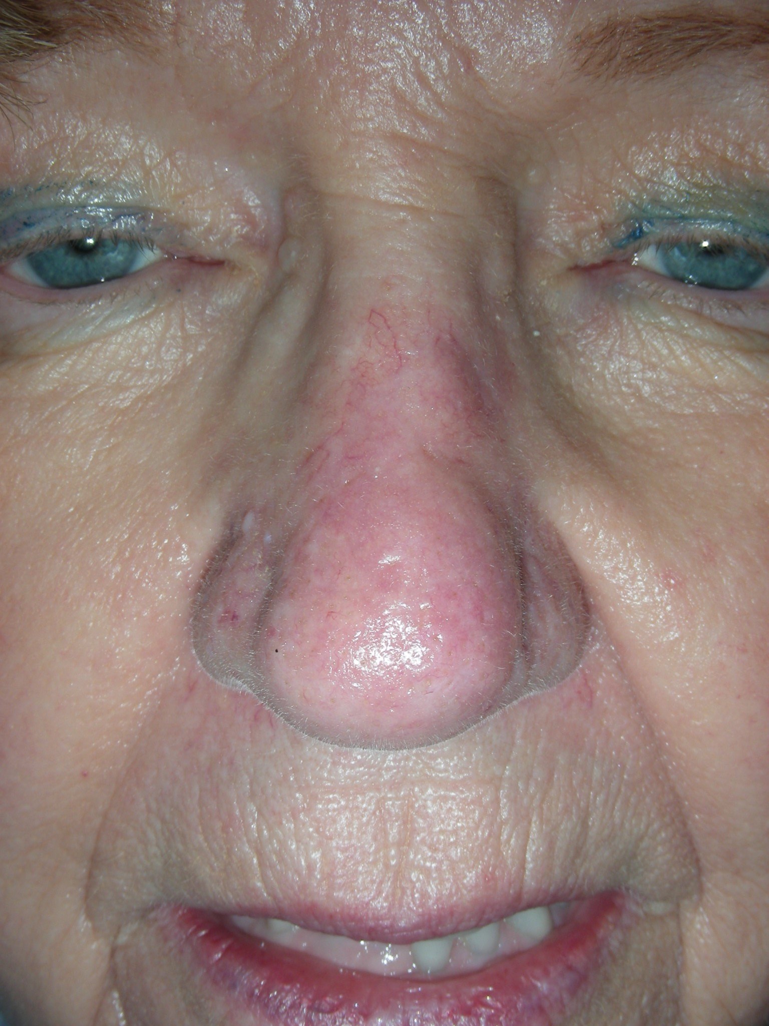 Mohs for Squamous Cell on Nose After Plastic Surgery