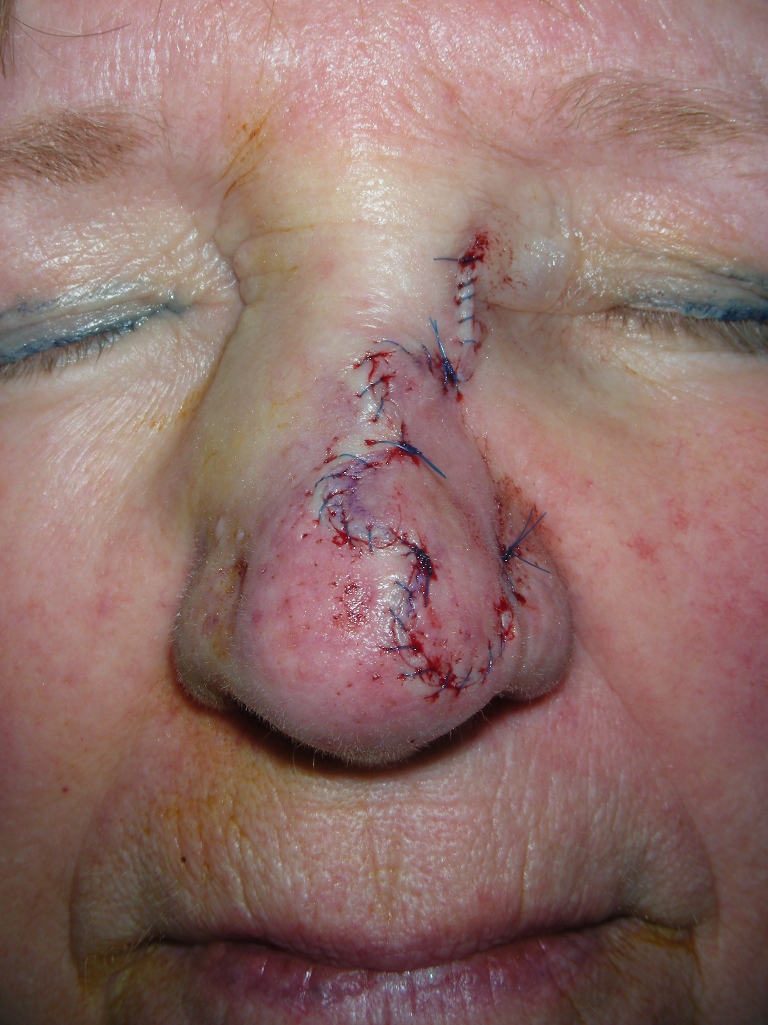 Trilobe Flap Trilobe Flap Sutures