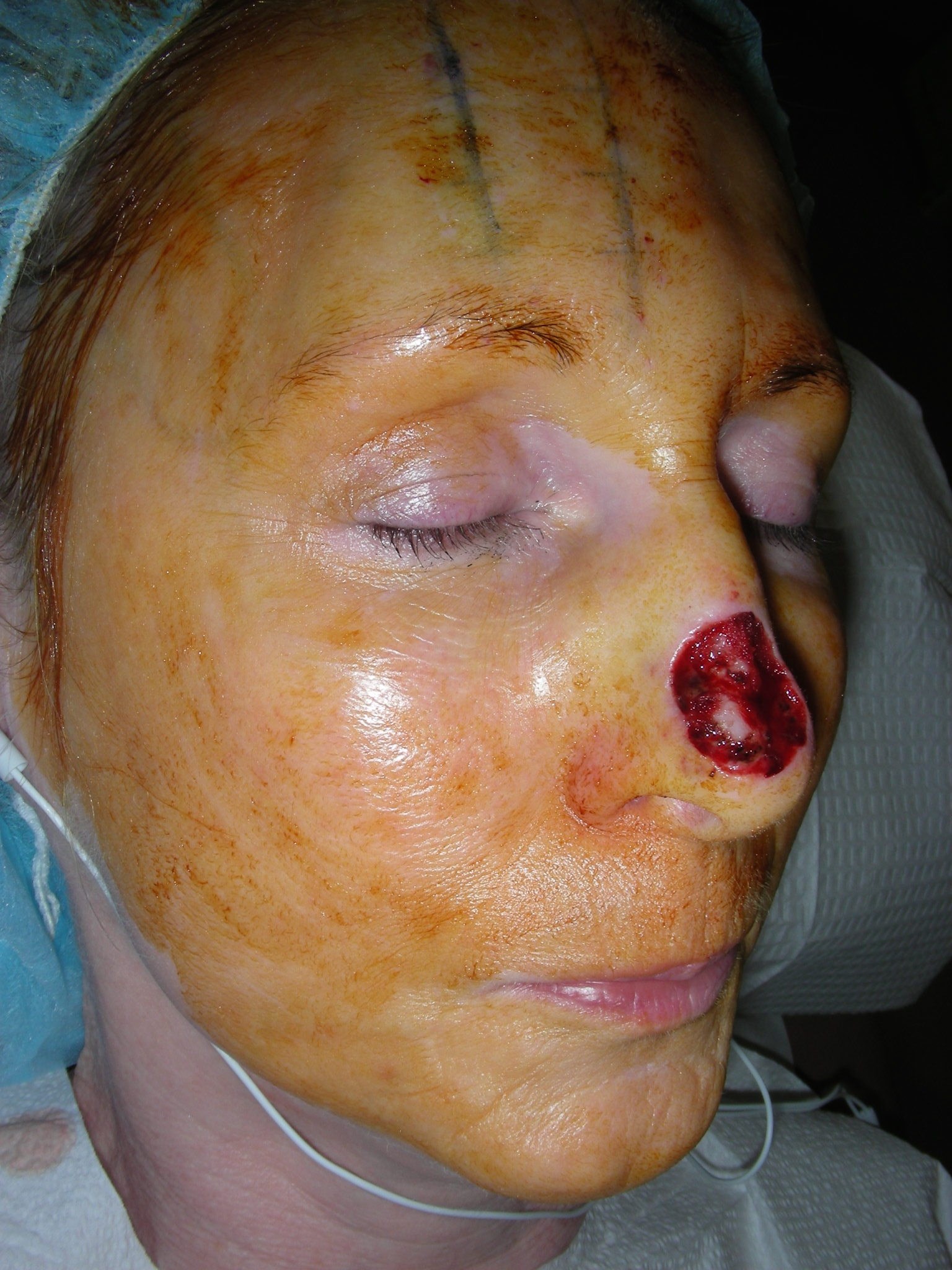 More photos from surgery Before reconstruction