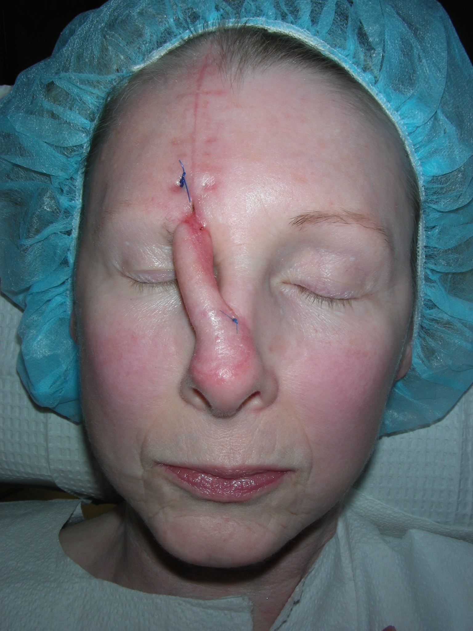 Multistage procedures 6 weeks after forehead flap