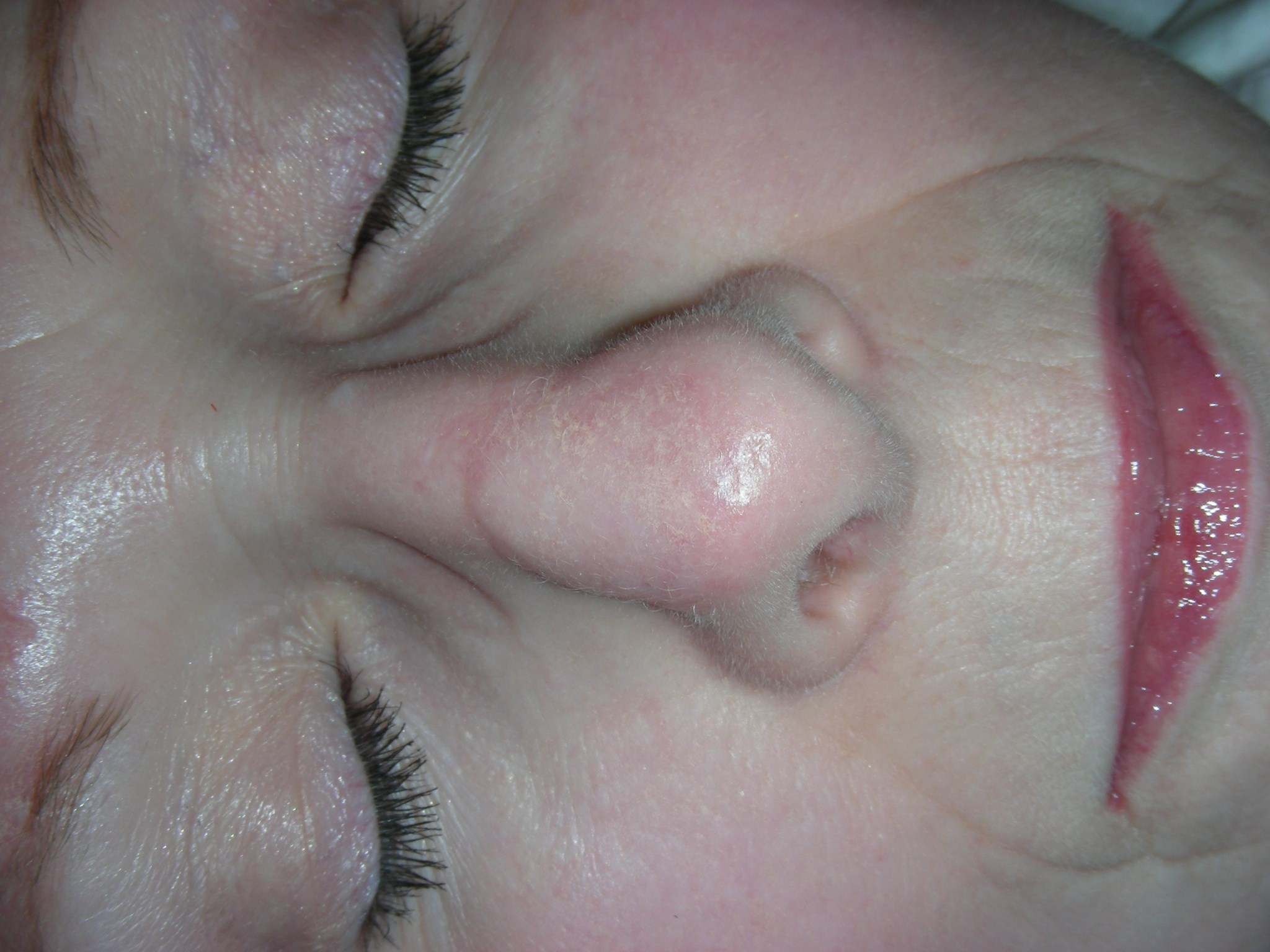Before scar revision Closeup before revision
