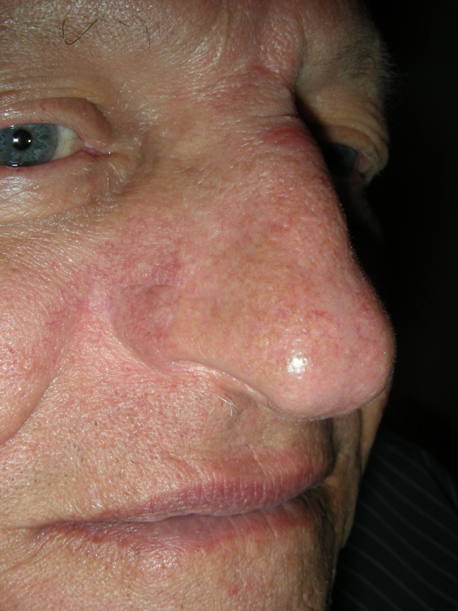 Basal Cell Cancer Alar Nose After