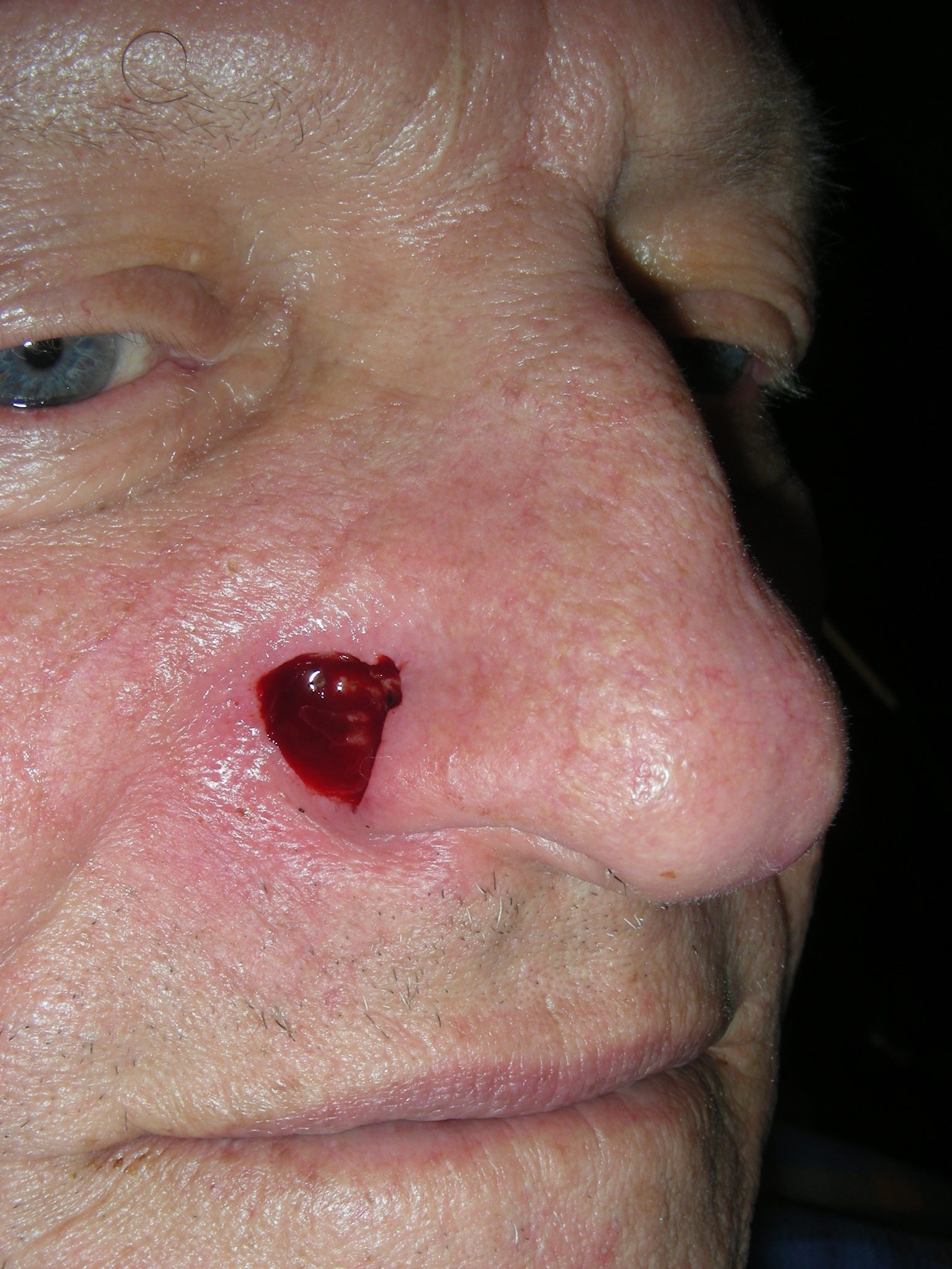 Basal Cell Cancer Alar Nose Before