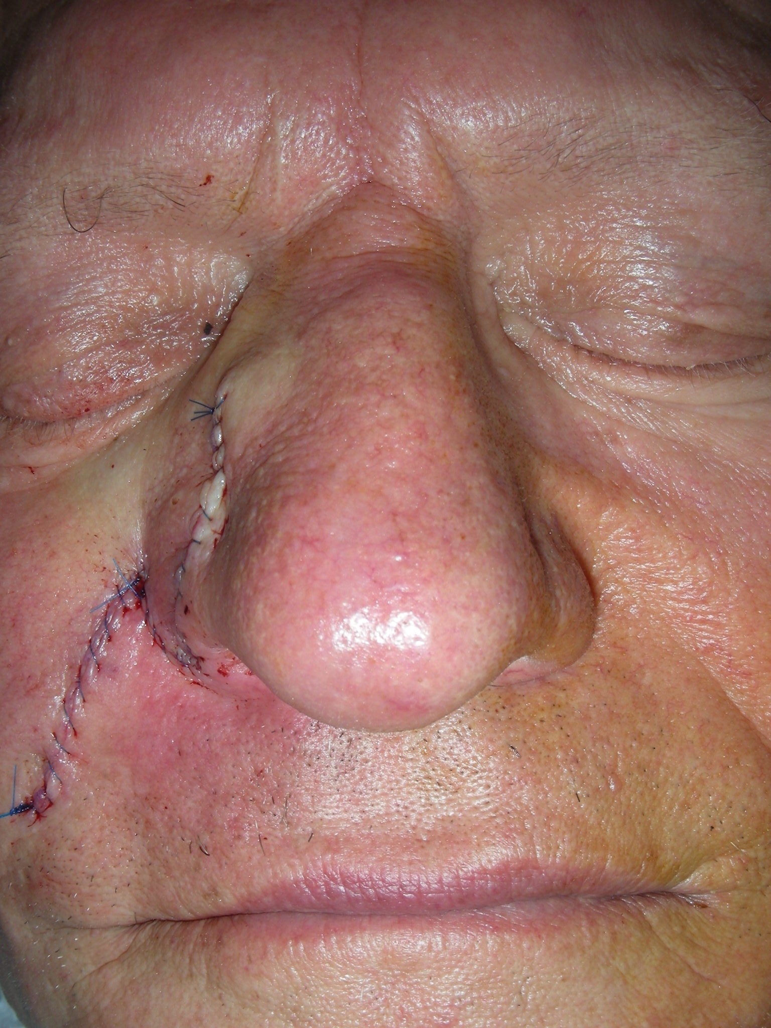 Closure with 2 Suture Layers Immediately after Repair