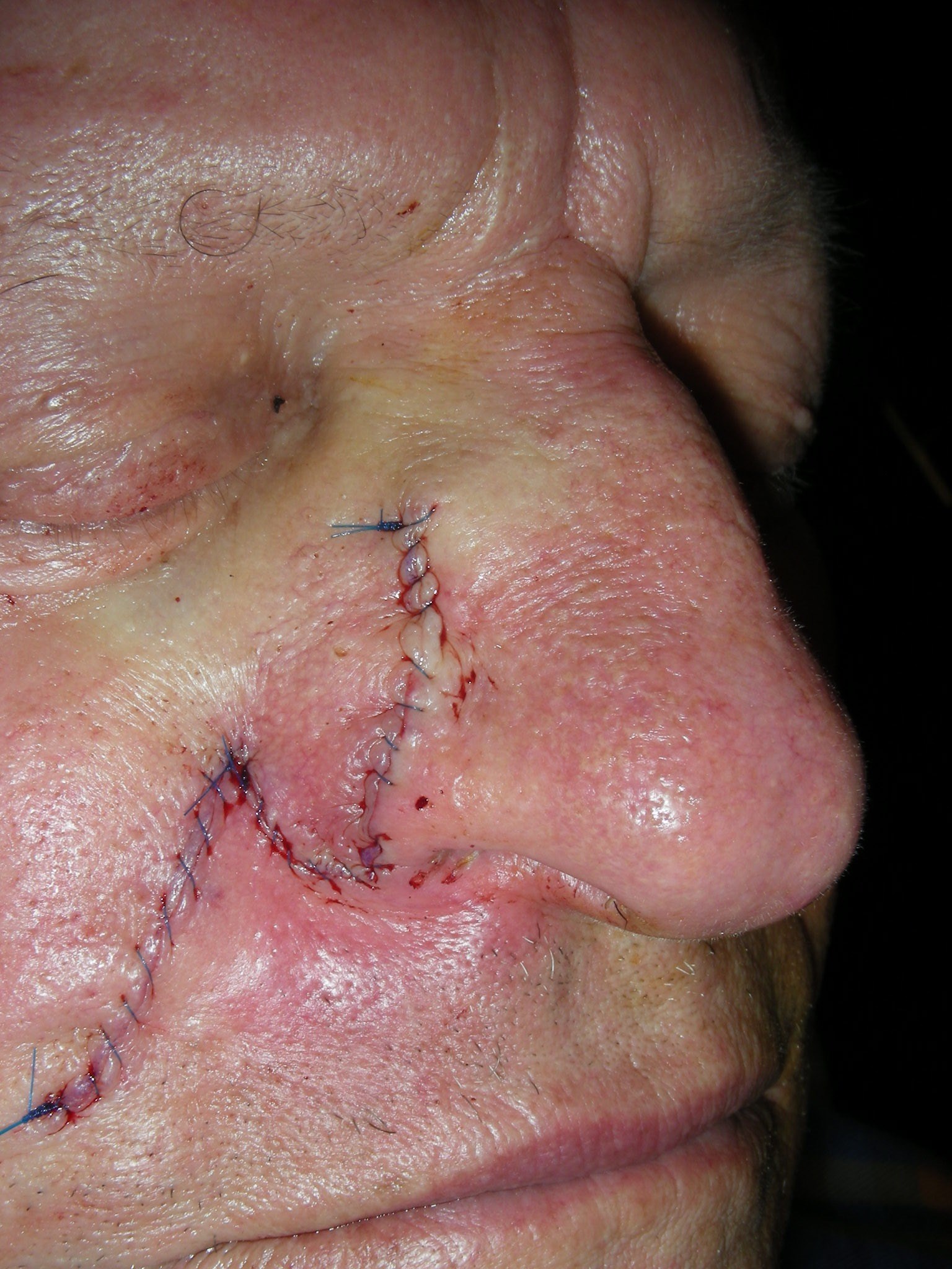 Closure with 2 Suture Layers Immediately after Repair