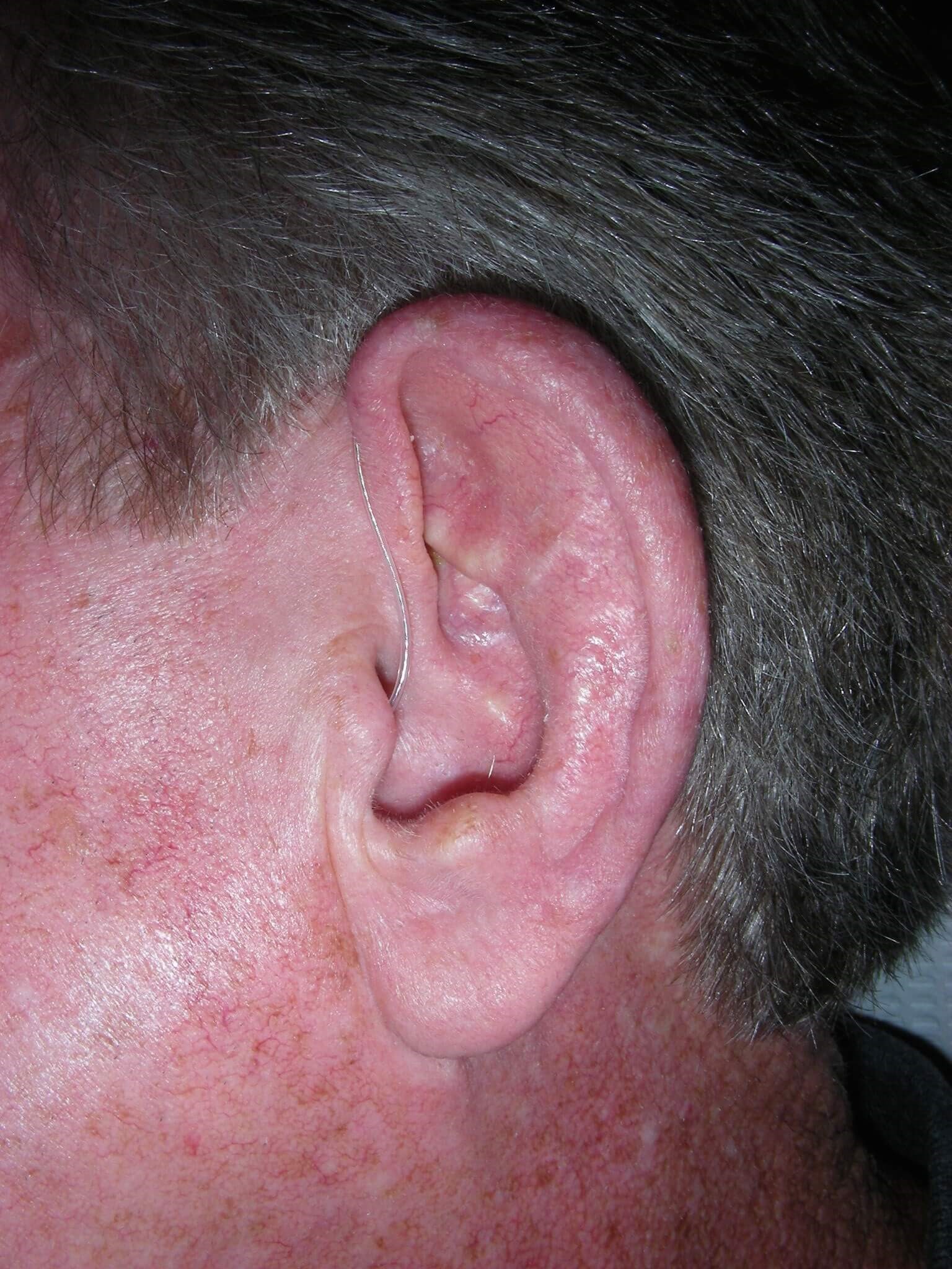 Typical "Helical Rim" Defect After Repair (7 weeks)