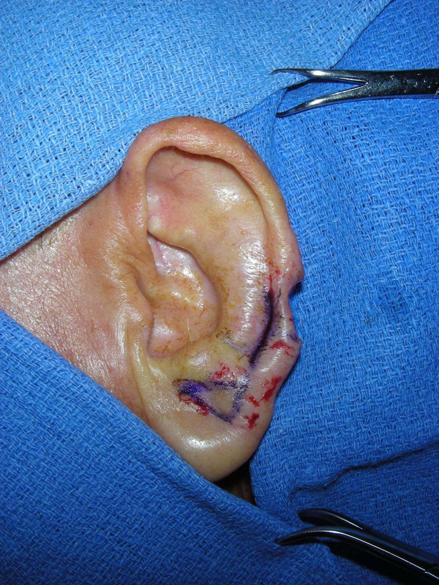 Antia-Buch Flap Surgical Plan