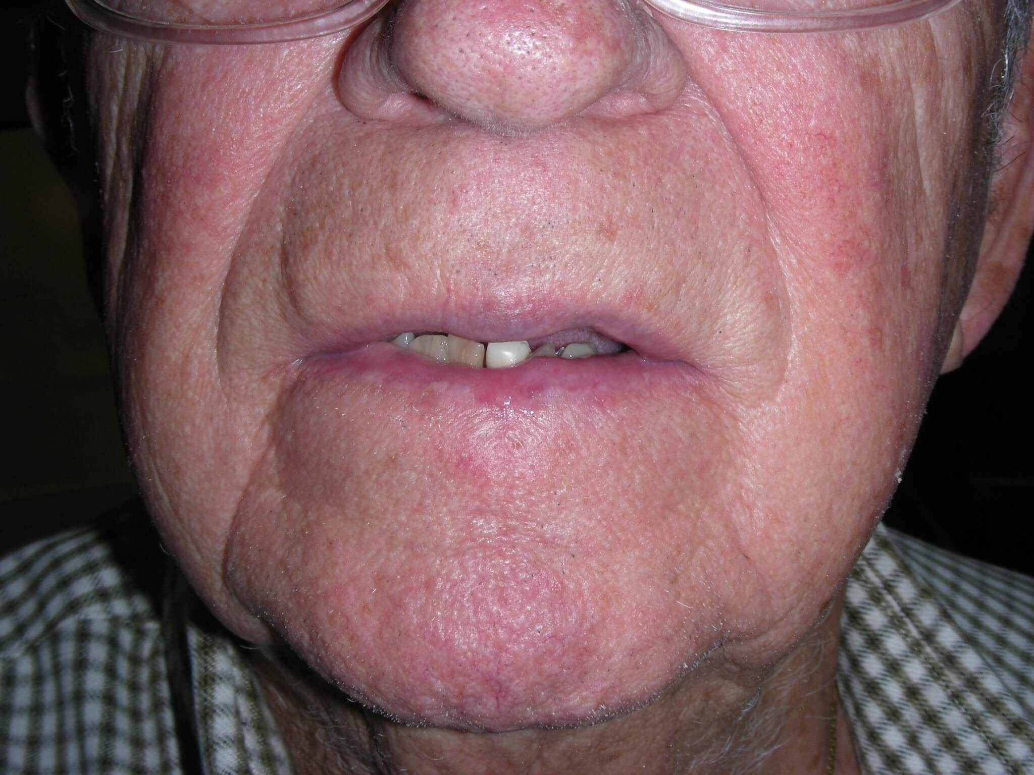 Lip Squamous Cell Carcinoma After