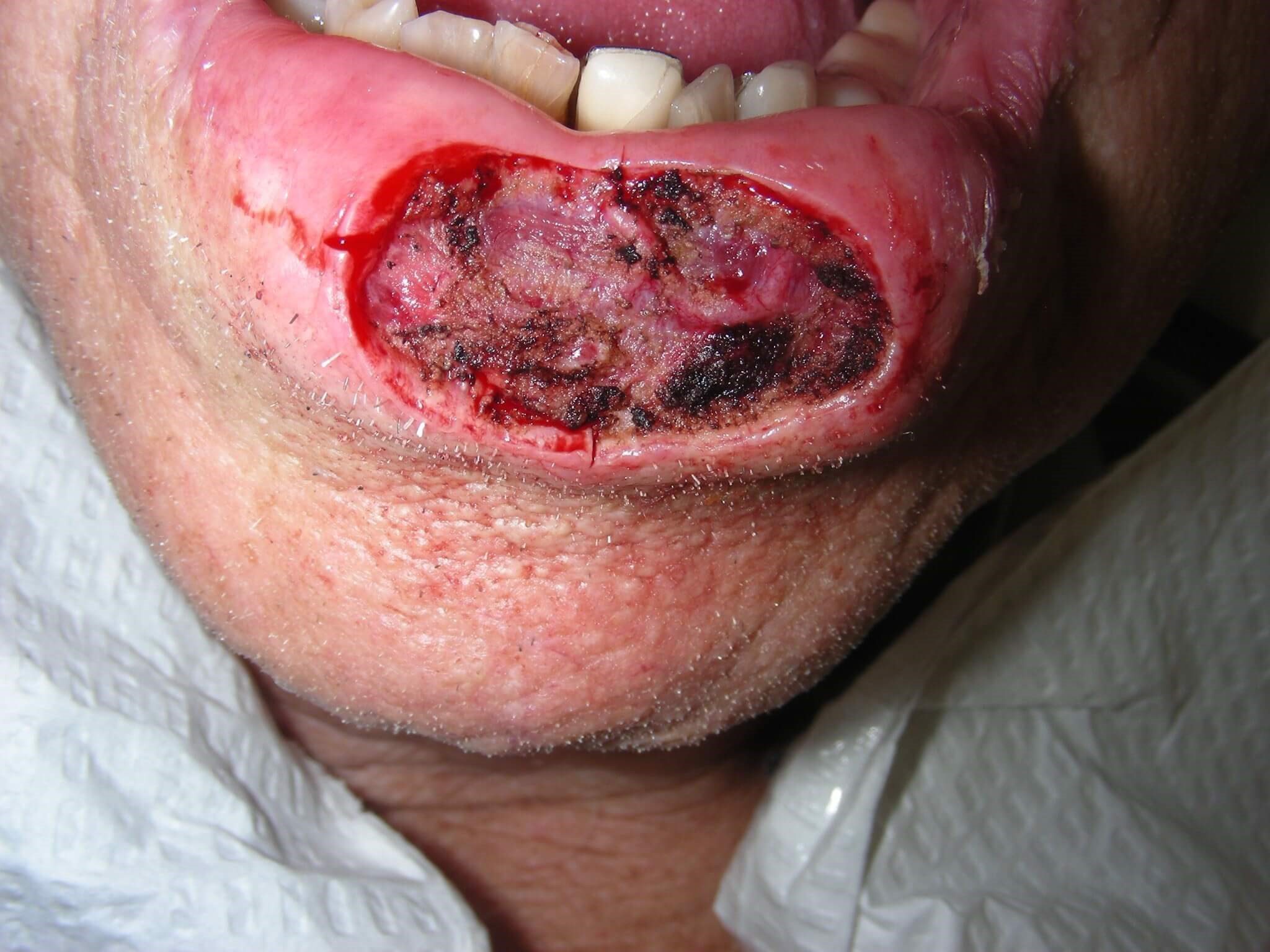 Lower lip Mohs Surgery Defect MOHS Surgery