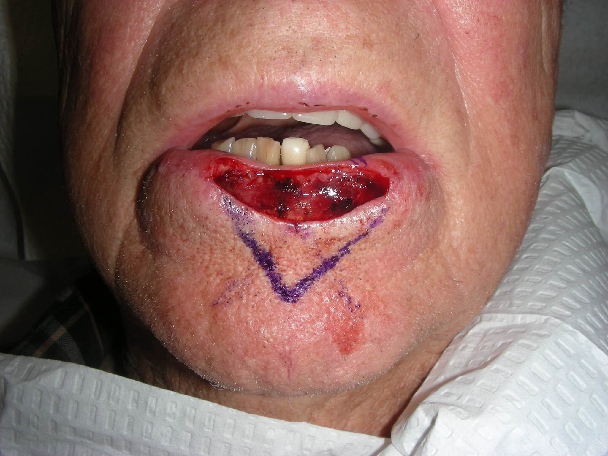 Lower lip Mohs Surgery Defect Reconstruction Plan