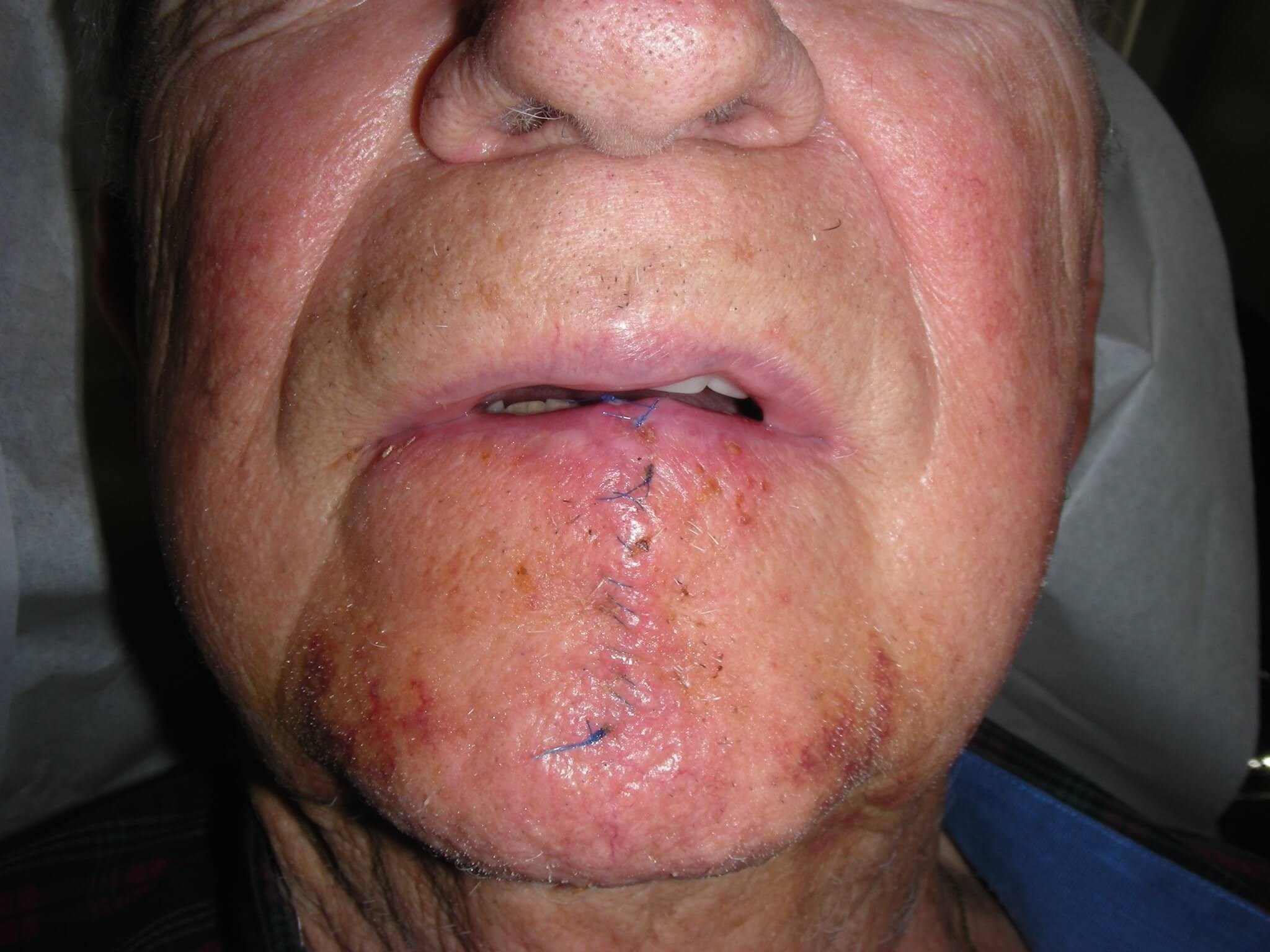 Post Reconstruction 1 Week Post OP