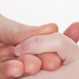 Warts