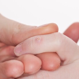 Warts